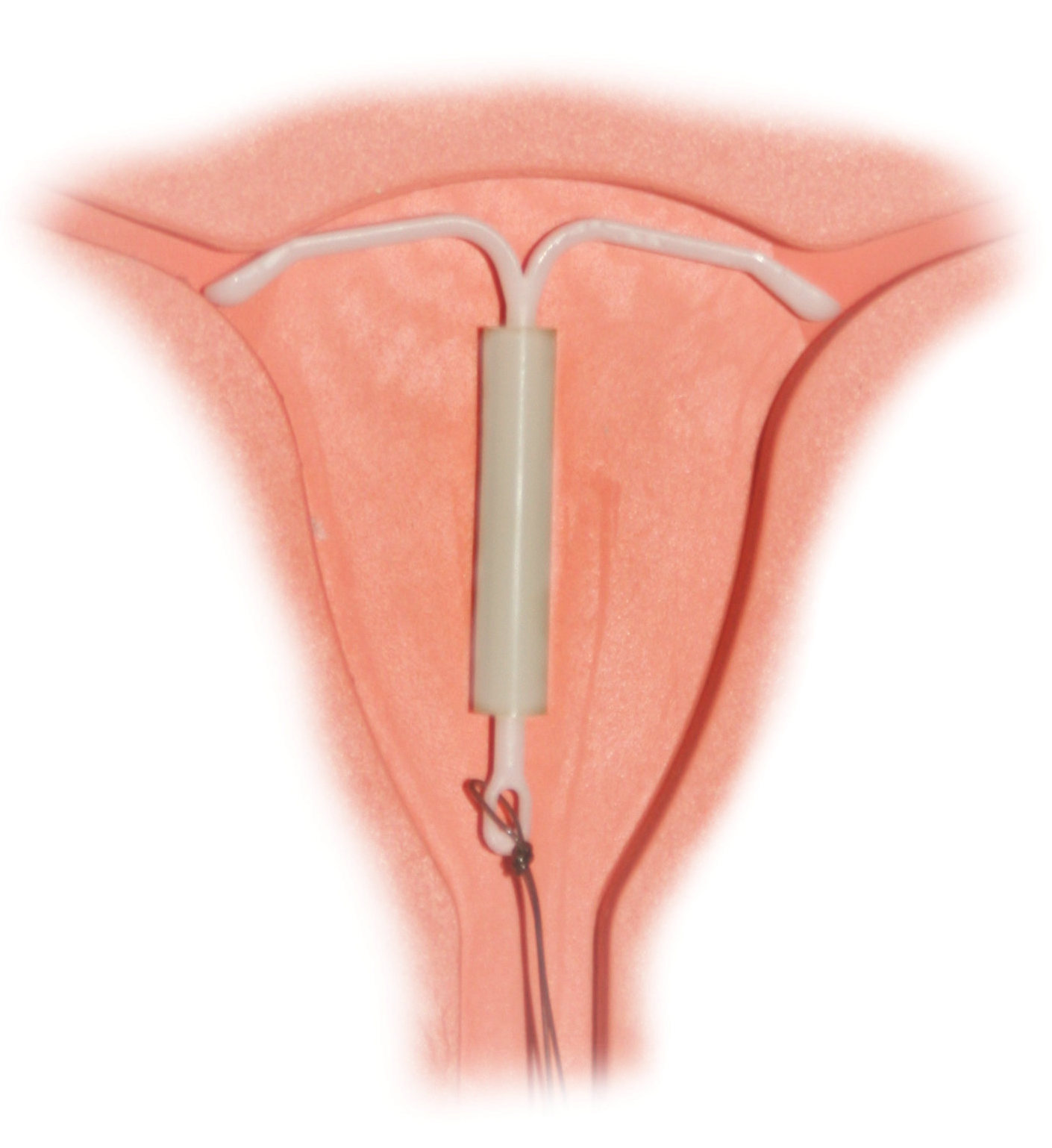 Mirena_IntraUterine_System